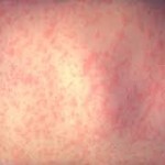 What they measles look like on human skin.